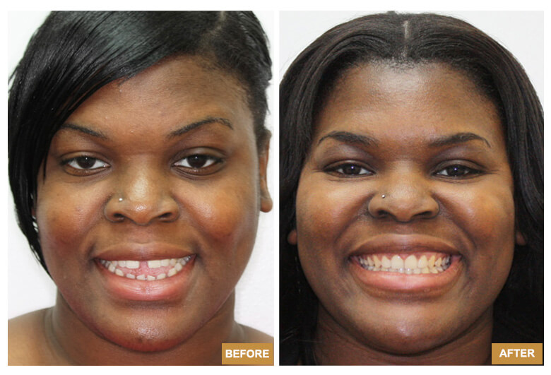 Invisalign Before After - Chase Patton, DDS, 03