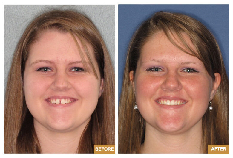 Invisalign Before After - Chase Patton, DDS, 02