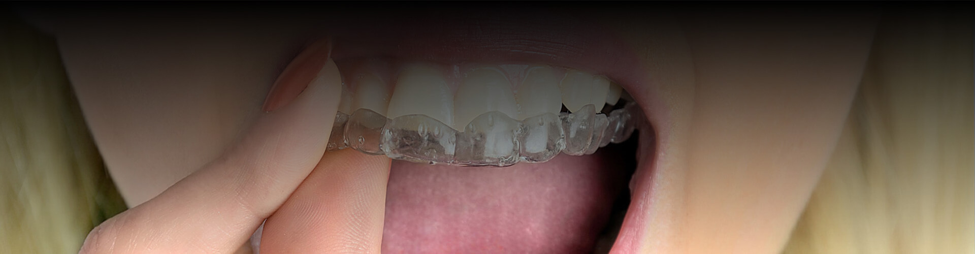 Closeup of woman wearing dental prosthetic on her teeth