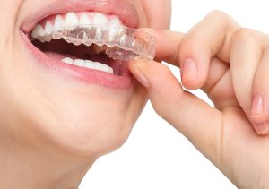 How Much is Invisalign in Columbia - Clear Teeth Aligners